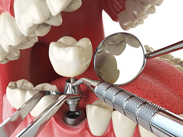 Best Emergency Root Canal Treatment in Lake City, IA